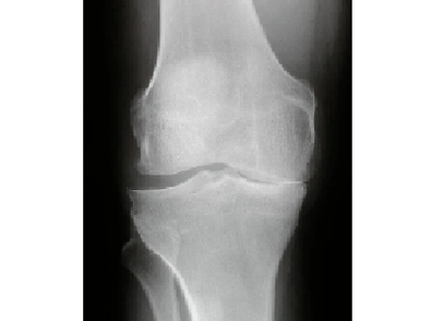 Diagnosis of arthrosis of the knee joint