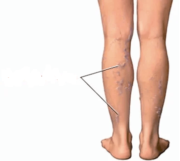 The consequences of knee arthrosis