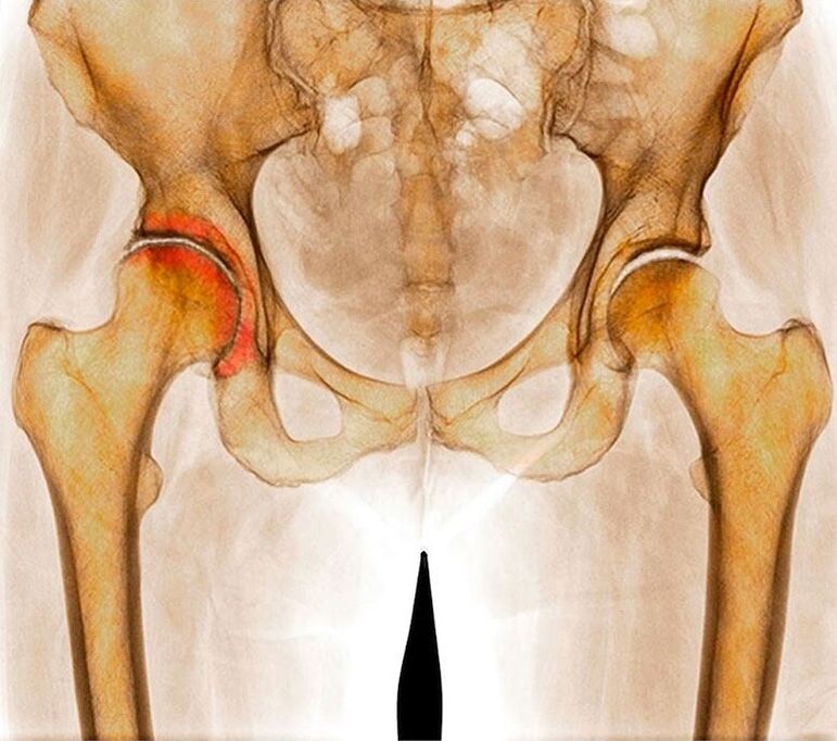 Arthrosis of the hip joint
