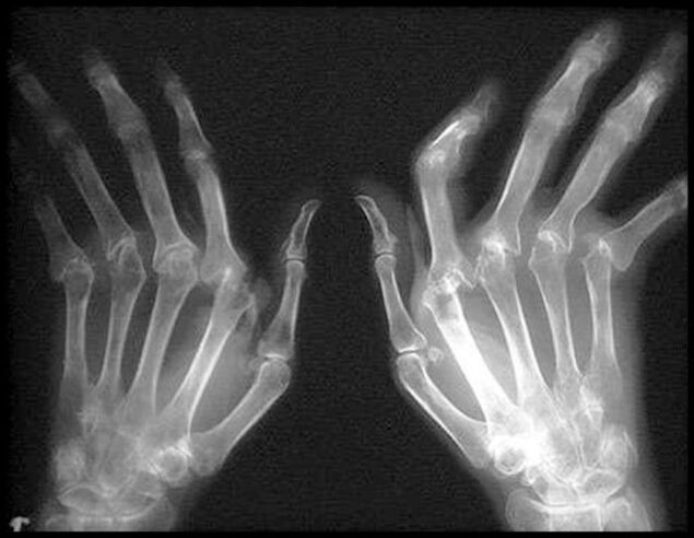 X -ray picture of the hands affected by arthrosis