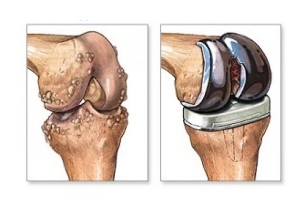 knee replacement for arthrosis