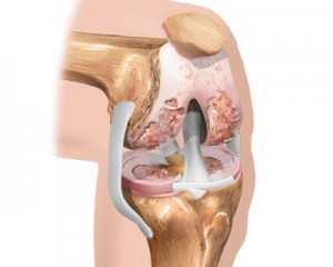 the initial stage of knee arthrosis