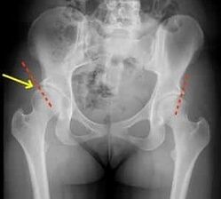 Methods for the treatment of arthrosis of the hip joint