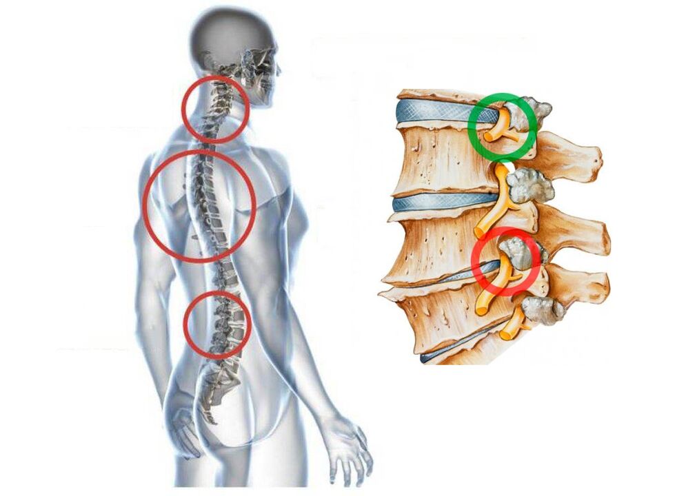 What does the cervical osteochondrosis of the vertebrae look like