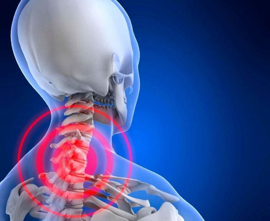 neck pain with cervical osteochondrosis