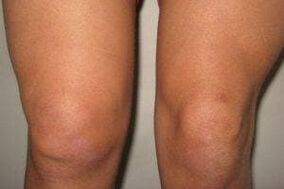 inflammation in the knee joint with arthritis and arthrosis