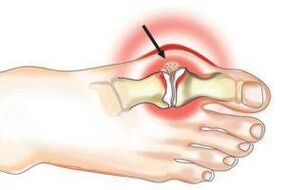 joint damage due to arthritis and arthrosis