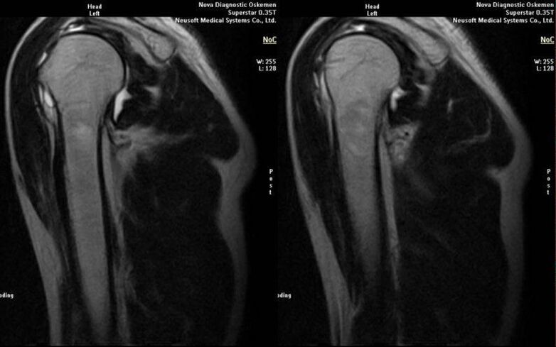 arthrosis of the shoulder joint on x-ray