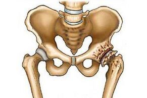 destruction of the hip joint in arthrosis