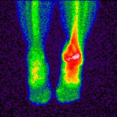 The method of differential diagnosis of crusarthrosis is scintigraphy