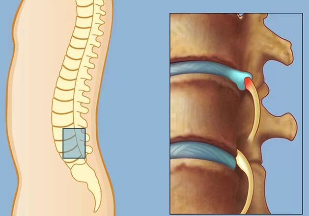 Rook syndrome